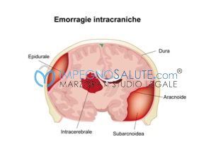 Emorragia cerebrale intraventricolare nel neonato