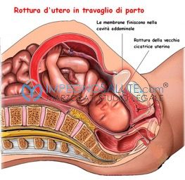 Rottura d’utero risarcimento danni per errore medico