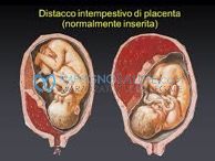 distacco della placenta