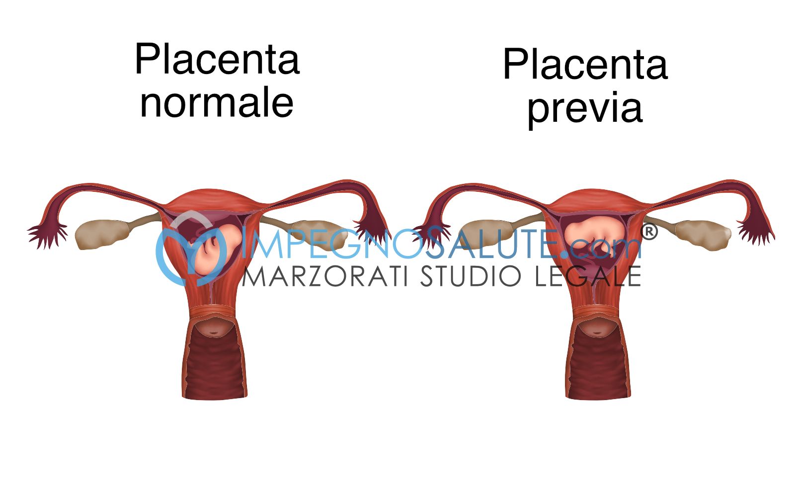 rischi della placenta previa