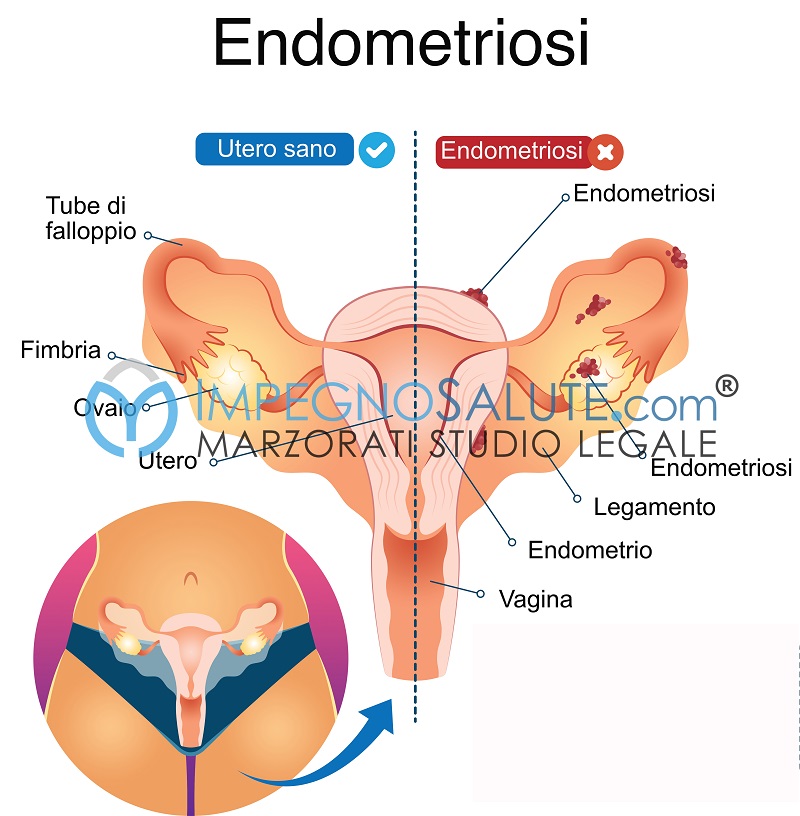Endometriosi avvocato malasanità