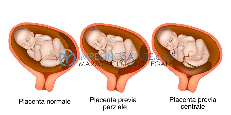 danni in gravidanza la placenta previa