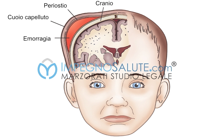 Emorragie cerebrali nel neonato