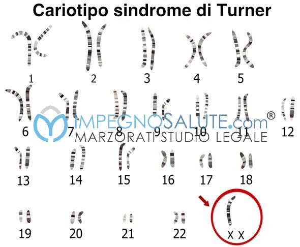 Sindrome di Turner malformazione malattie feto