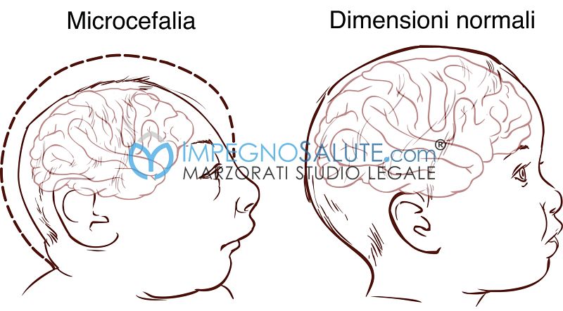 Microcefalia