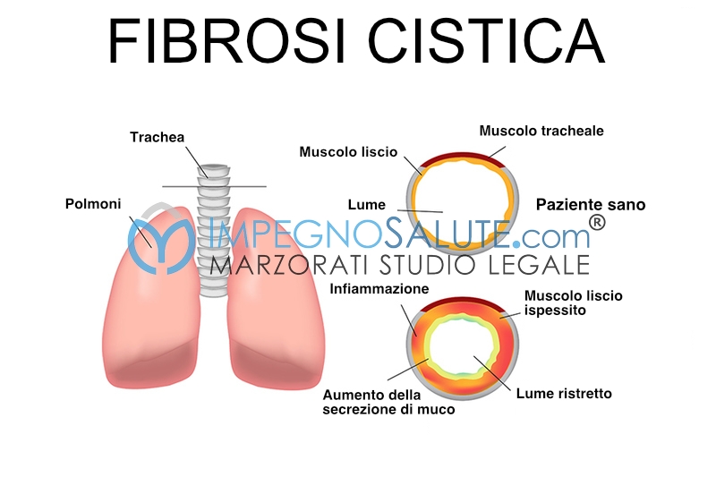 Fibrosi-cistica