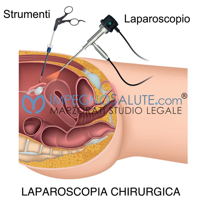Chirurgia laparoscopica ginecologia
