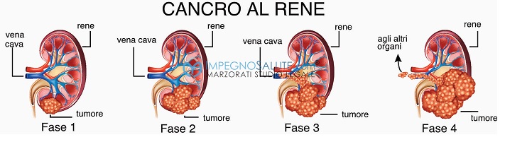 Cancro rene