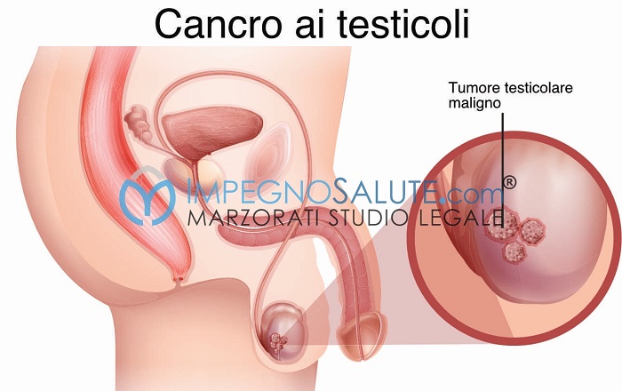 Cancro ai testicoli