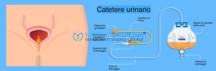 Catetere urinario