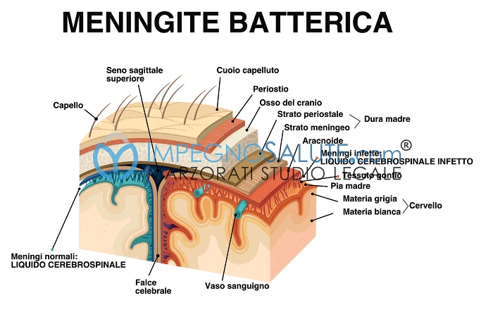 meningite batterica